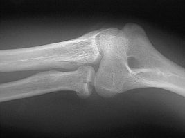 Radial-Head-Fracture